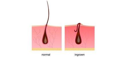 Ingrown Hair Akibat Sering Mencabut Bulu Ketiak